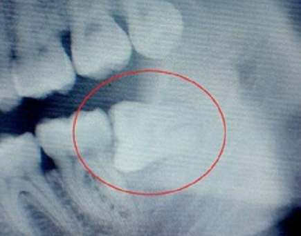 深圳牙科医院讲述冠周炎如何治疗